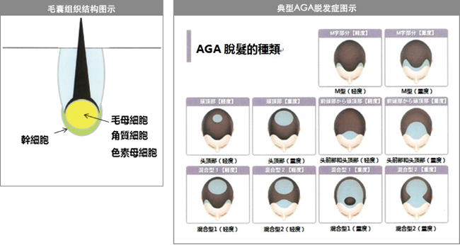 什麼是AGA脂溢性脫髮癥