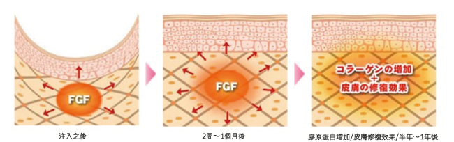肌膚再生FGF注射療法